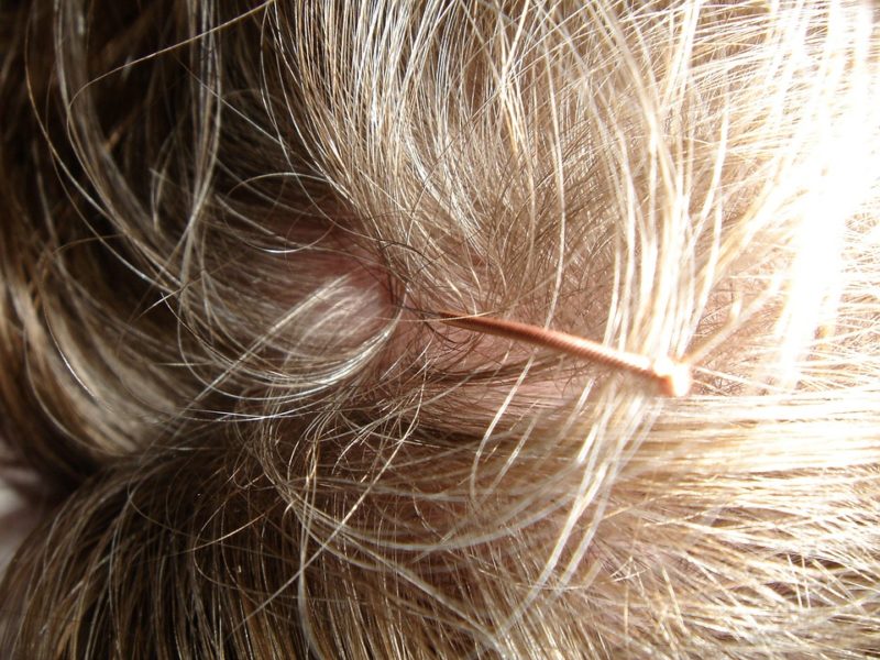 akupunktura proti vypadávání vlasů